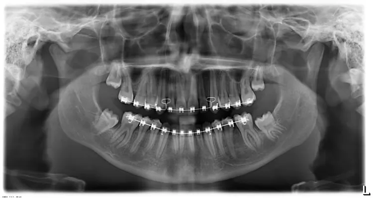 Wisdom Teeth After Wisdom Teeth After