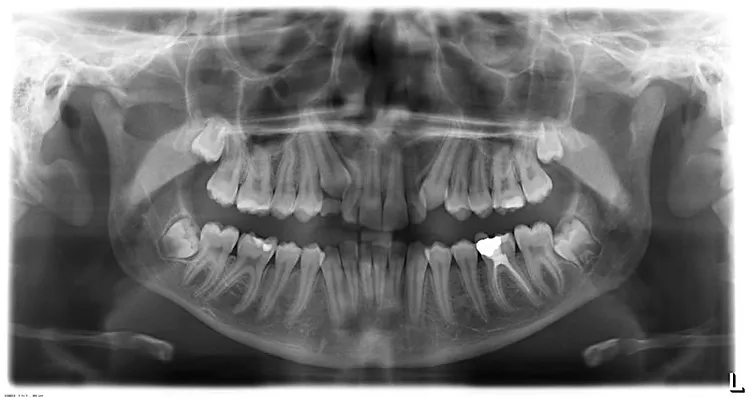 Wisdom Teeth Before Wisdom Teeth Before