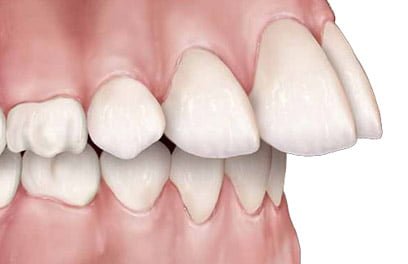 frontal Upper Front Teeth Protrusion