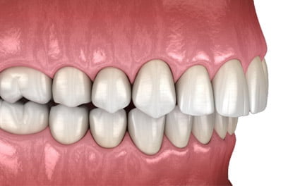 Overbite Overbite