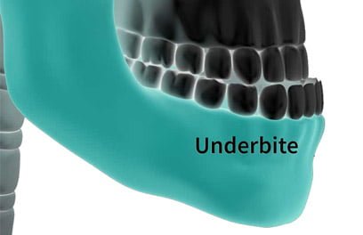Underbite Underbite